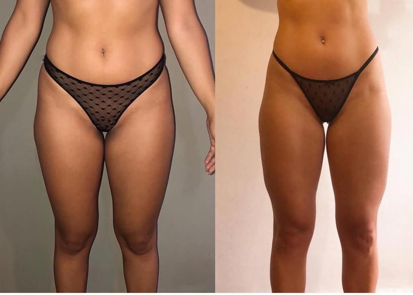 Antes y después de Patricia, 6 meses con TAMFIT